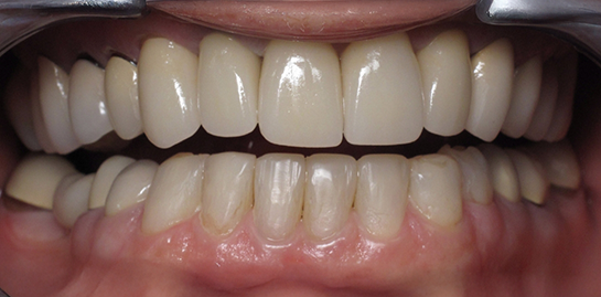 Carol's teeth after treatment