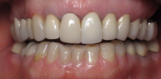 Carol's teeth before treatment