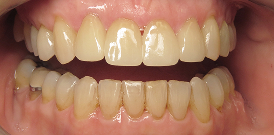 Cathy's teeth after treatment