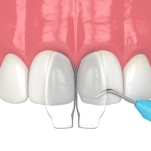 Illustration of cosmetic bonding for upper teeth