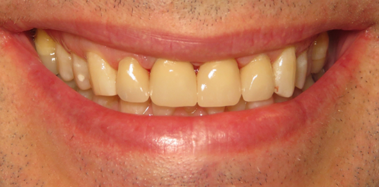 David's teeth after treatment