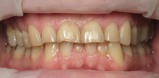 David's teeth before treatment