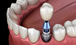 Illustration of single dental implant