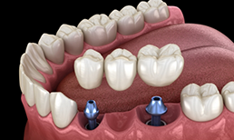 Illustration of implant bridge being placed