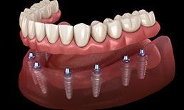 Illustration of denture and dental implants