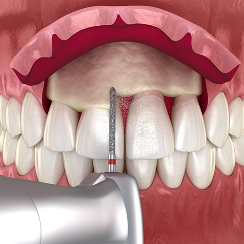 Illustration of crown lengthening for upper teeth