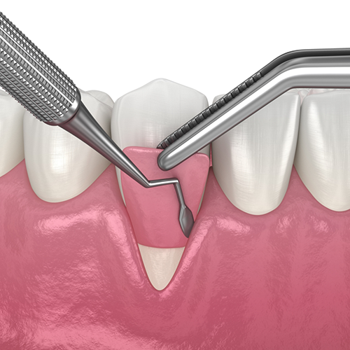 Illustration of gum grafting for lower tooth