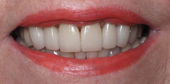 Helen's teeth after treatment