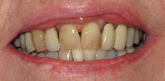 Helen's teeth before treatment