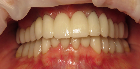 Judith's teeth after treatment