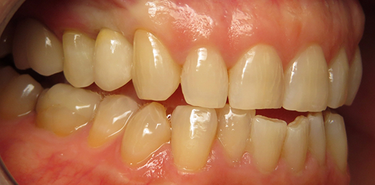 Lana's teeth after treatment