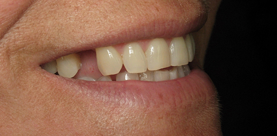 Lana's teeth before treatment