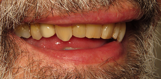 Leif's teeth after treatment