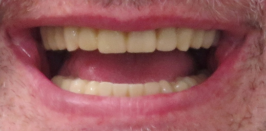 Mike's teeth after treatment