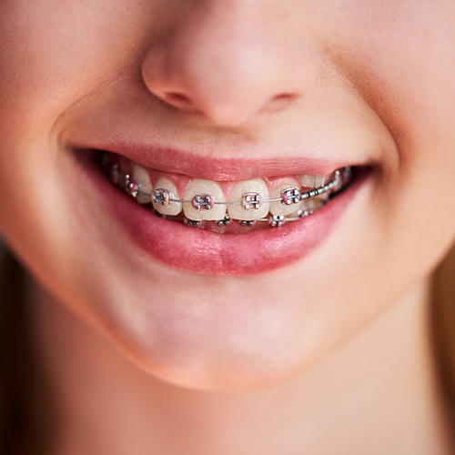 Close up of smile with braces