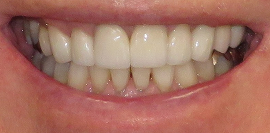 Randy's teeth after treatment