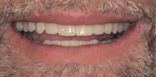 Robert's teeth after treatment