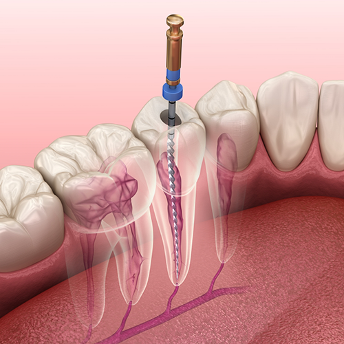 Illustration of file being used for root canal treatment in Langley