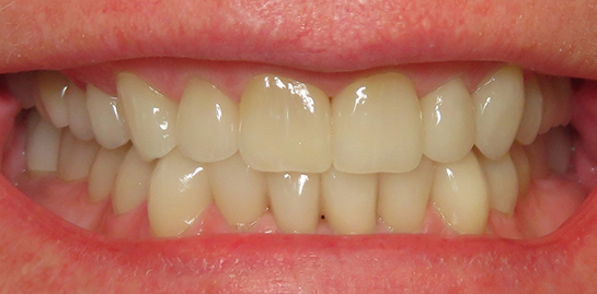 Ruanne's teeth after treatment