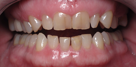 Ruanne's teeth before treatment