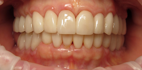 Shirley's teeth after treatment