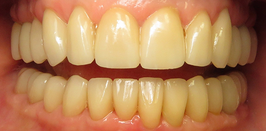 Teresa's teeth after treatment