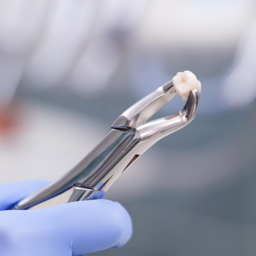 Gloved hand holding forcep with tooth